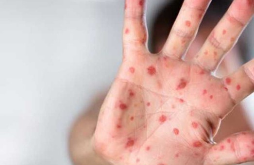 На Харківщині зафіксували 18 випадків кору